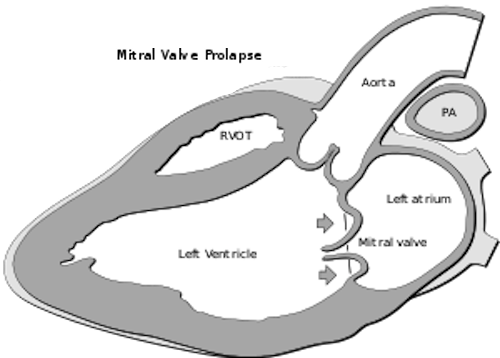 Mitral Valve Prolapse
